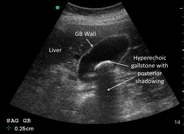 will-ultrasound-show-gallstones